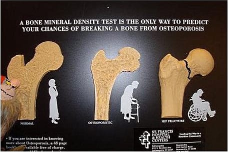 bone-density-screening