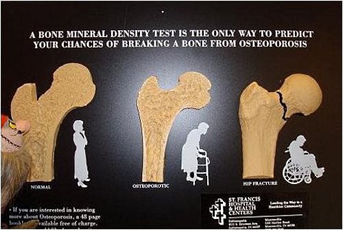 bone-density-screening