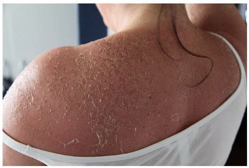 tips-for-avoiding-melanoma